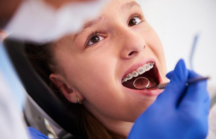 יישור שיניים שקוף – כמה זה עולה