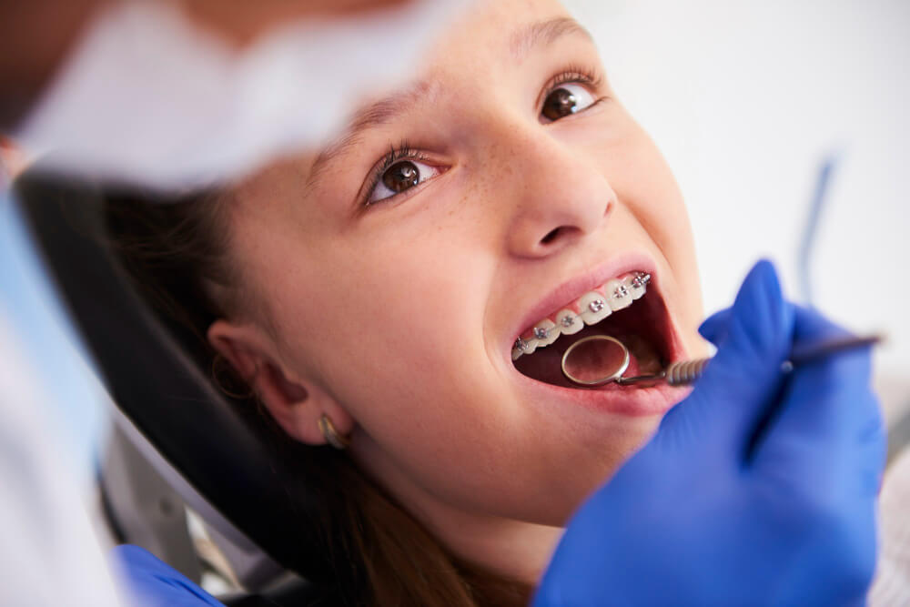 יישור שיניים שקוף – כמה זה עולה